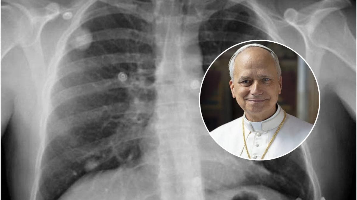 Adenocarcinoma pulmonar: por qué el tumor del Papa puede no dar síntomas iniciales